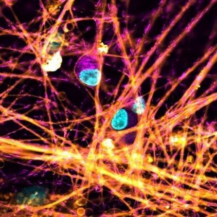 These images are of iPSCs derived from Friedreich's ataxia patients, which have been differentiated into sensory neurons