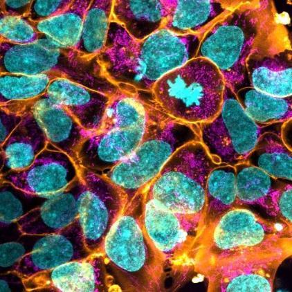 iPSCs derived from Friedreich's ataxia patients, which have been differentiated into sensory neurons