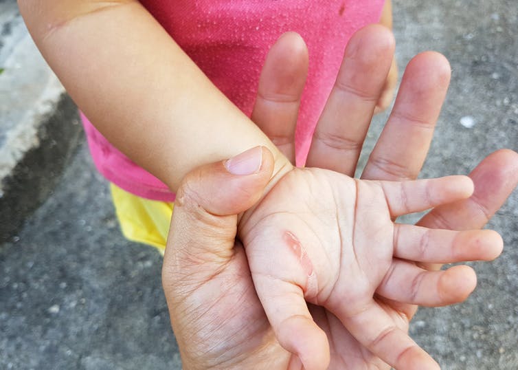 A child shows a burn on her hand. photo: Shutterstock