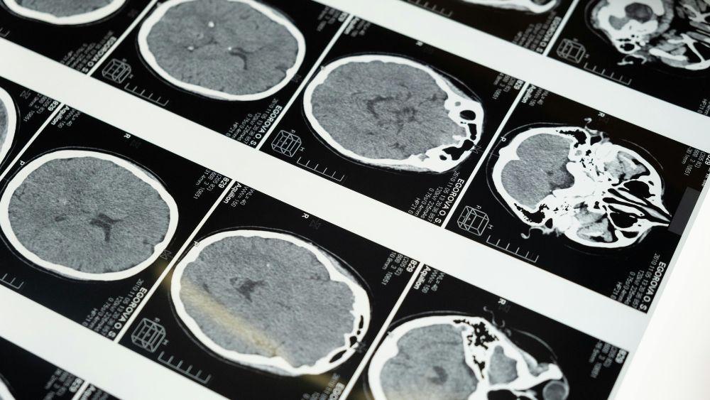Black and white MRI image of a brain.